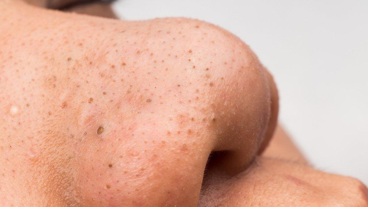 Siyah Nokta Hakkında Bilgiler | Farmasi Blog